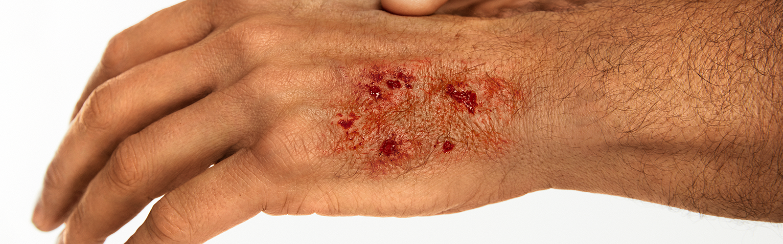 Medical expert holding a wounded man’s hand with bite wound. Medical expert holding a wounded man’s hand with bite wound.